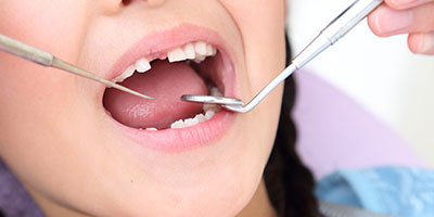乳歯のむし歯は永久歯にも影響